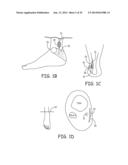 MINIMALLY INVASIVE IMPLANTABLE NEUROSTIMULATION SYSTEM diagram and image