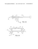 MINIMALLY INVASIVE IMPLANTABLE NEUROSTIMULATION SYSTEM diagram and image