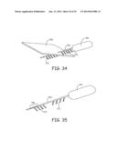 MINIMALLY INVASIVE IMPLANTABLE NEUROSTIMULATION SYSTEM diagram and image