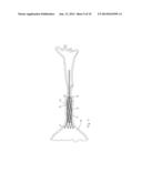 Lumen Occluding Stent, Delivery Catheter and Method diagram and image