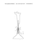 Lumen Occluding Stent, Delivery Catheter and Method diagram and image