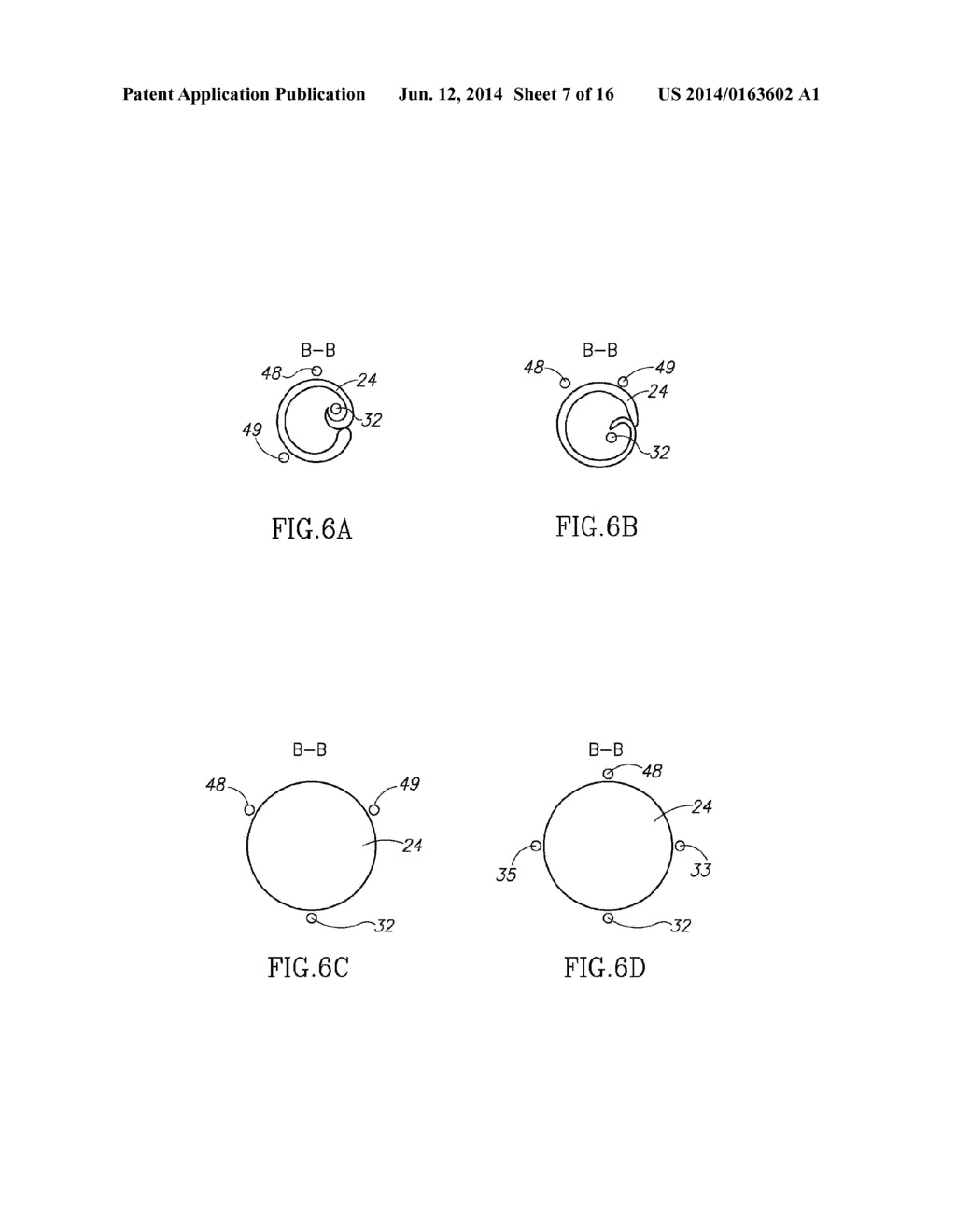 SYSTEMS AND METHODS FOR TREATING A VESSEL USING FOCUSED FORCE - diagram, schematic, and image 08