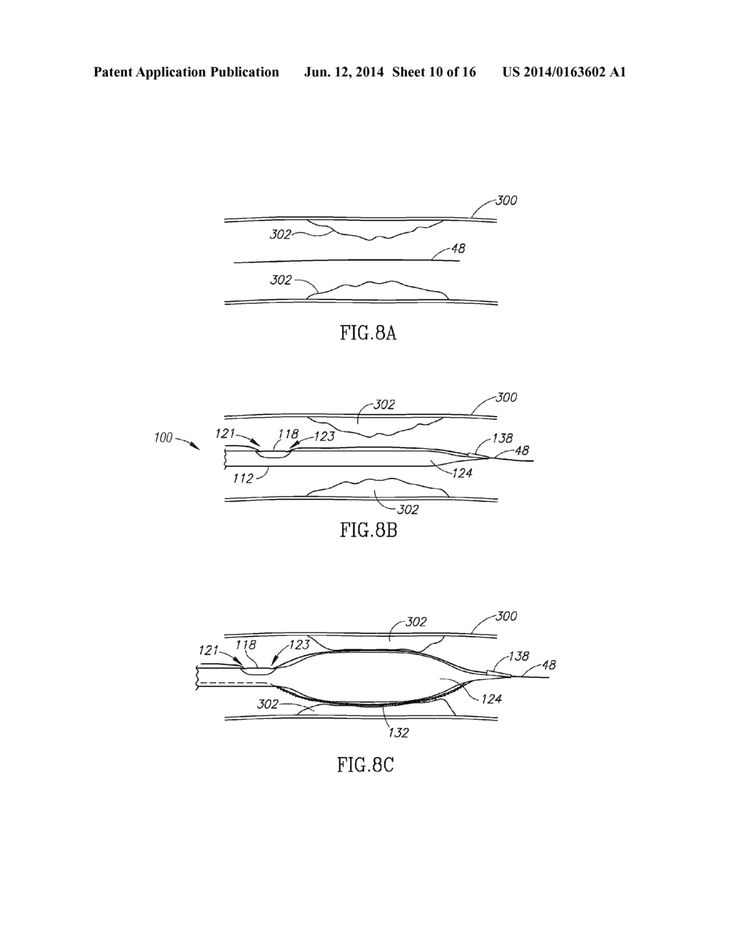 SYSTEMS AND METHODS FOR TREATING A VESSEL USING FOCUSED FORCE - diagram, schematic, and image 11