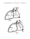 FILTER APPARATUS FOR OSTIUM OF LEFT ATRIAL APPENDAGE diagram and image