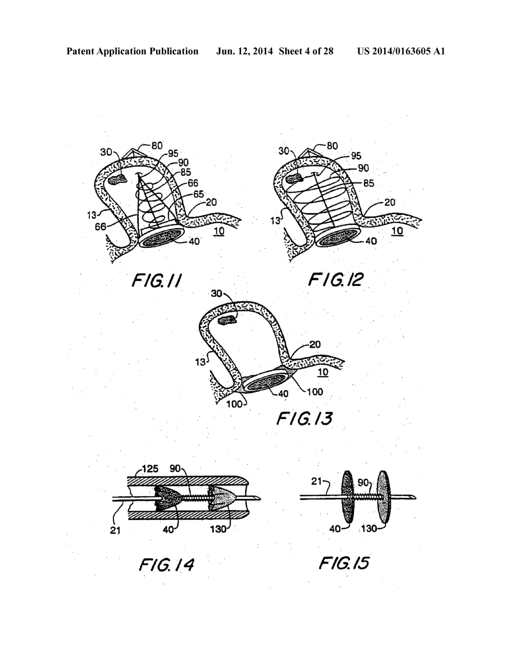 FILTER APPARATUS FOR OSTIUM OF LEFT ATRIAL APPENDAGE - diagram, schematic, and image 05