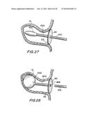 FILTER APPARATUS FOR OSTIUM OF LEFT ATRIAL APPENDAGE diagram and image