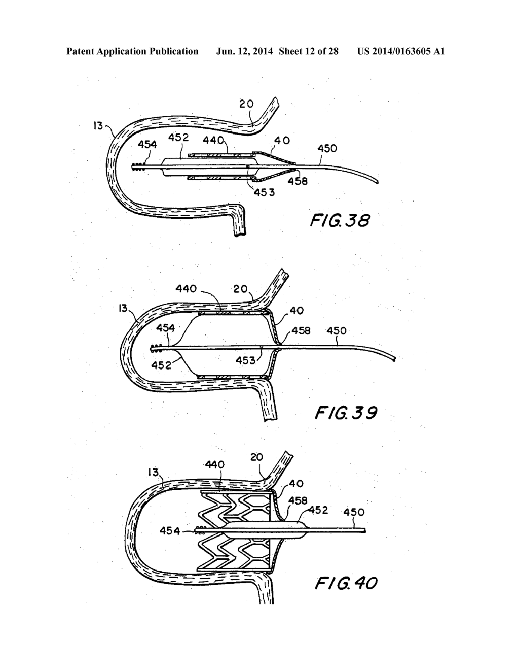 FILTER APPARATUS FOR OSTIUM OF LEFT ATRIAL APPENDAGE - diagram, schematic, and image 13