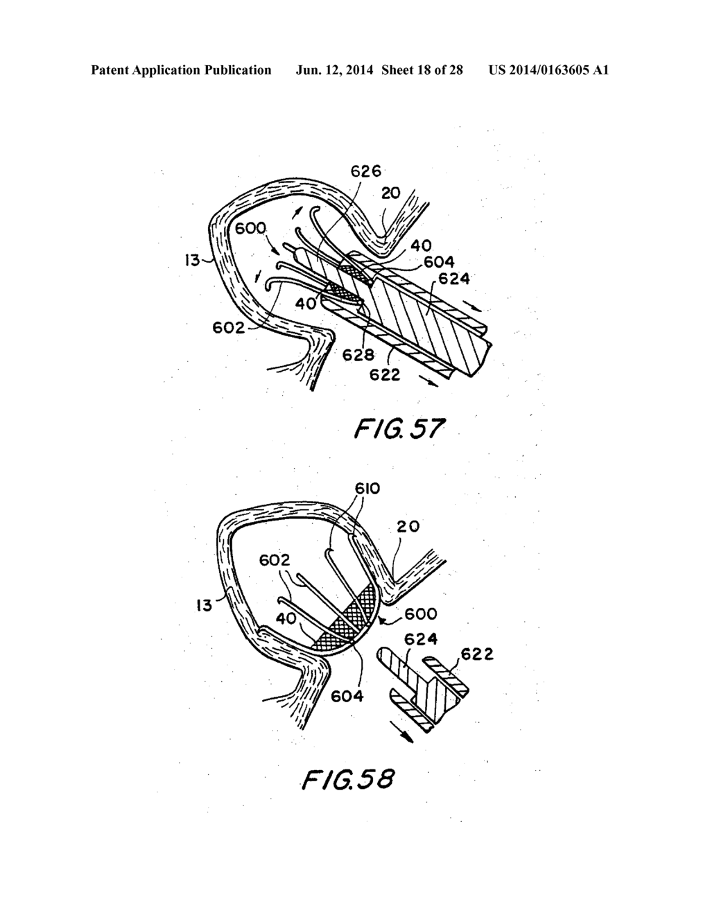 FILTER APPARATUS FOR OSTIUM OF LEFT ATRIAL APPENDAGE - diagram, schematic, and image 19