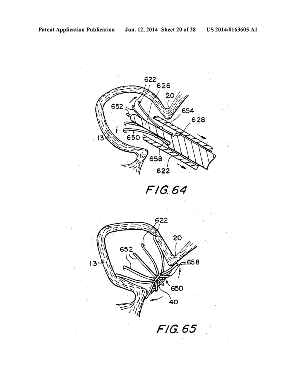 FILTER APPARATUS FOR OSTIUM OF LEFT ATRIAL APPENDAGE - diagram, schematic, and image 21