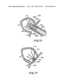 FILTER APPARATUS FOR OSTIUM OF LEFT ATRIAL APPENDAGE diagram and image