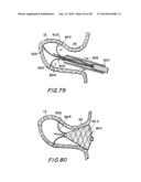 FILTER APPARATUS FOR OSTIUM OF LEFT ATRIAL APPENDAGE diagram and image