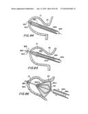 FILTER APPARATUS FOR OSTIUM OF LEFT ATRIAL APPENDAGE diagram and image