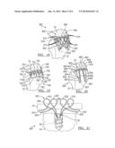 Method And Apparatus For Soft Tissue Fixation diagram and image