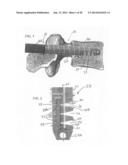 Bone Screw with Deflectable Portion diagram and image