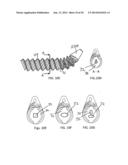 Bone Screw with Deflectable Portion diagram and image