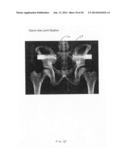 Bone Screw with Deflectable Portion diagram and image