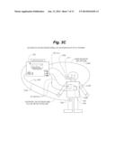 COORDINATED MEDIUM VOLTAGE THERAPY FOR IMPROVING EFFECTIVENESS OF     DEFIBRILLATION THERAPY diagram and image