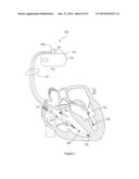 METHOD AND APPARATUS TO ENSURE CONSISTENT LEFT VENTRICULAR PACING diagram and image