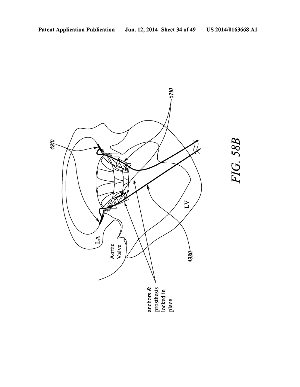 METHODS AND SYSTEMS FOR DELIVERING PROSTHESES USING RAIL TECHNIQUES - diagram, schematic, and image 35