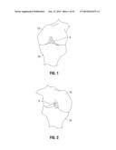 APPARATUS AND METHOD FOR RECONSTRUCTING A LIGAMENT diagram and image