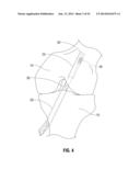 APPARATUS AND METHOD FOR RECONSTRUCTING A LIGAMENT diagram and image