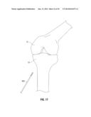 APPARATUS AND METHOD FOR RECONSTRUCTING A LIGAMENT diagram and image