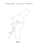 APPARATUS AND METHOD FOR RECONSTRUCTING A LIGAMENT diagram and image