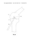 APPARATUS AND METHOD FOR RECONSTRUCTING A LIGAMENT diagram and image