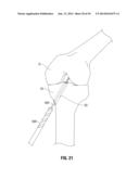 APPARATUS AND METHOD FOR RECONSTRUCTING A LIGAMENT diagram and image