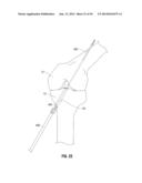 APPARATUS AND METHOD FOR RECONSTRUCTING A LIGAMENT diagram and image