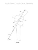 APPARATUS AND METHOD FOR RECONSTRUCTING A LIGAMENT diagram and image