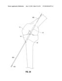 APPARATUS AND METHOD FOR RECONSTRUCTING A LIGAMENT diagram and image