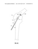 APPARATUS AND METHOD FOR RECONSTRUCTING A LIGAMENT diagram and image