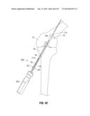 APPARATUS AND METHOD FOR RECONSTRUCTING A LIGAMENT diagram and image