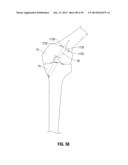 APPARATUS AND METHOD FOR RECONSTRUCTING A LIGAMENT diagram and image