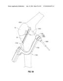 APPARATUS AND METHOD FOR RECONSTRUCTING A LIGAMENT diagram and image