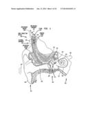 Securable Implantable Component diagram and image