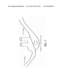 Cannula For Minimizing Dilution Of Dosing During Nitric Oxide Delivery diagram and image