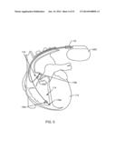 RF FILTER FOR AN ACTIVE MEDICAL DEVICE (AMD) FOR HANDLING HIGH RF POWER     INDUCED IN AN ASSOCIATED IMPLANTED LEAD FROM AN EXTERNAL RF FIELD diagram and image