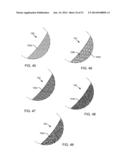 RF FILTER FOR AN ACTIVE MEDICAL DEVICE (AMD) FOR HANDLING HIGH RF POWER     INDUCED IN AN ASSOCIATED IMPLANTED LEAD FROM AN EXTERNAL RF FIELD diagram and image