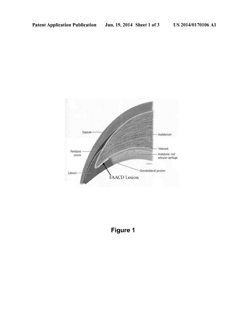 METHODS AND COMPOSITIONS SUITABLE FOR IMPROVED REATTACHMENT OF DETACHED     CARTILAGE TO SUBCHONDRAL BONE - diagram, schematic, and image 02