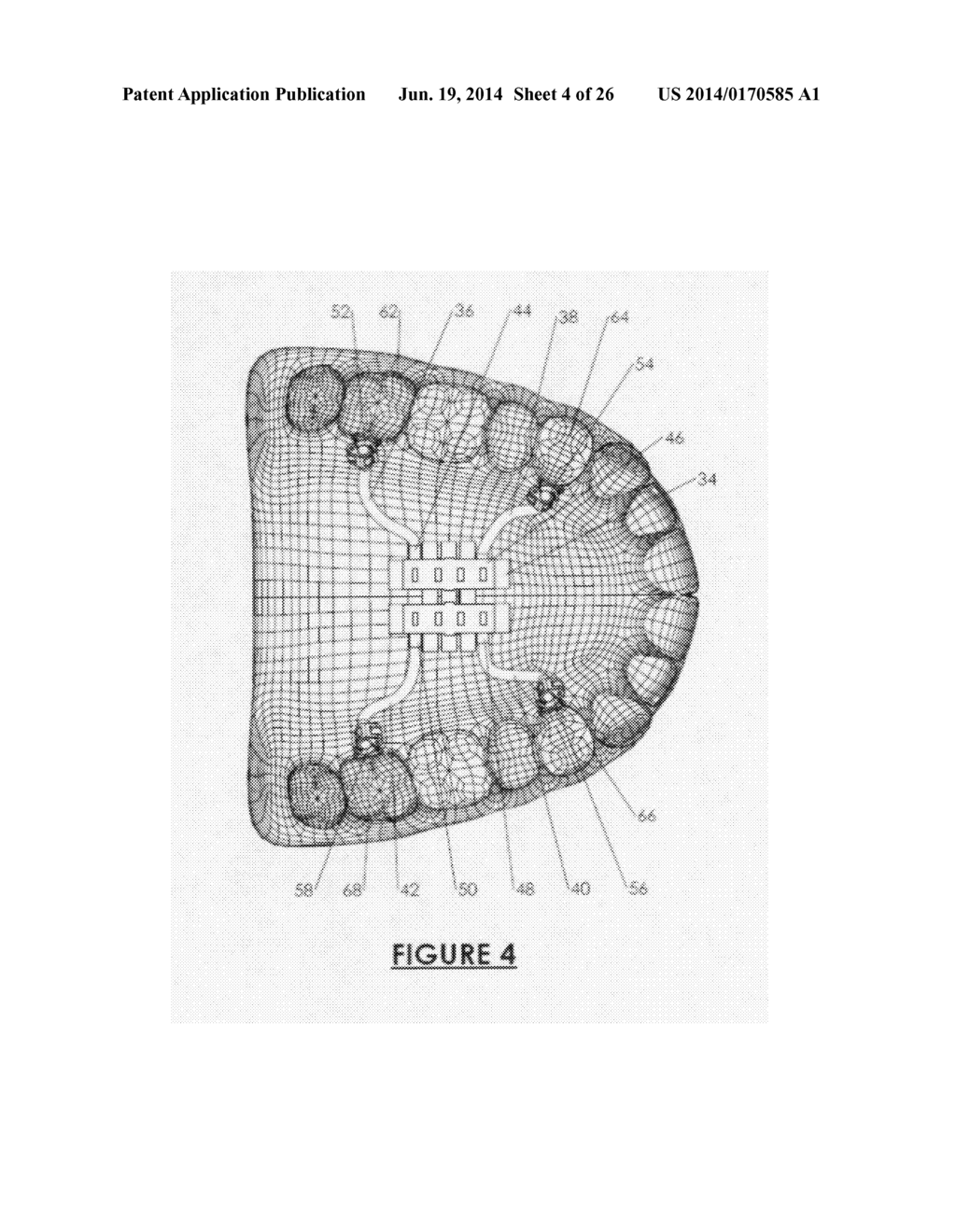 Orthodontic Appliance Anchoring Method and Apparatus - diagram, schematic, and image 05