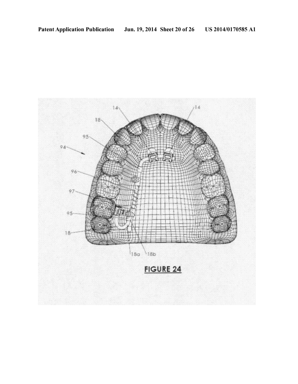 Orthodontic Appliance Anchoring Method and Apparatus - diagram, schematic, and image 21