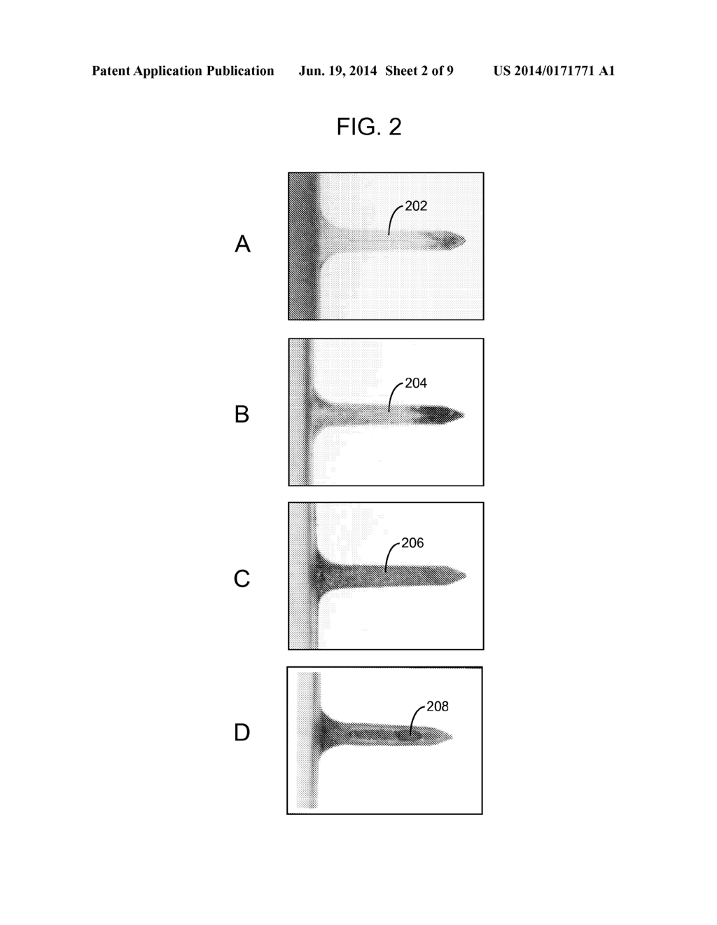 DERMAL LAYER ANALYTE SENSING DEVICES AND METHODS - diagram, schematic, and image 03