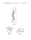 PEDICLE SCREW ASSEMBLY diagram and image