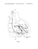 METHOD AND APPARATUS FOR RIGHT VENTRICULAR RESYNCHRONIZATION diagram and image