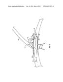 VASCULAR STENTING FOR ANEURYSMS diagram and image