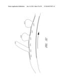 VASCULAR STENTING FOR ANEURYSMS diagram and image