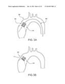 VERTICAL COAPTATION ZONE IN A PLANAR PORTION OF PROSTHETIC HEART VALVE     LEAFLET diagram and image