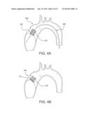 PROSTHETIC HEART VALVE WITH LEAFLET SHELVING diagram and image